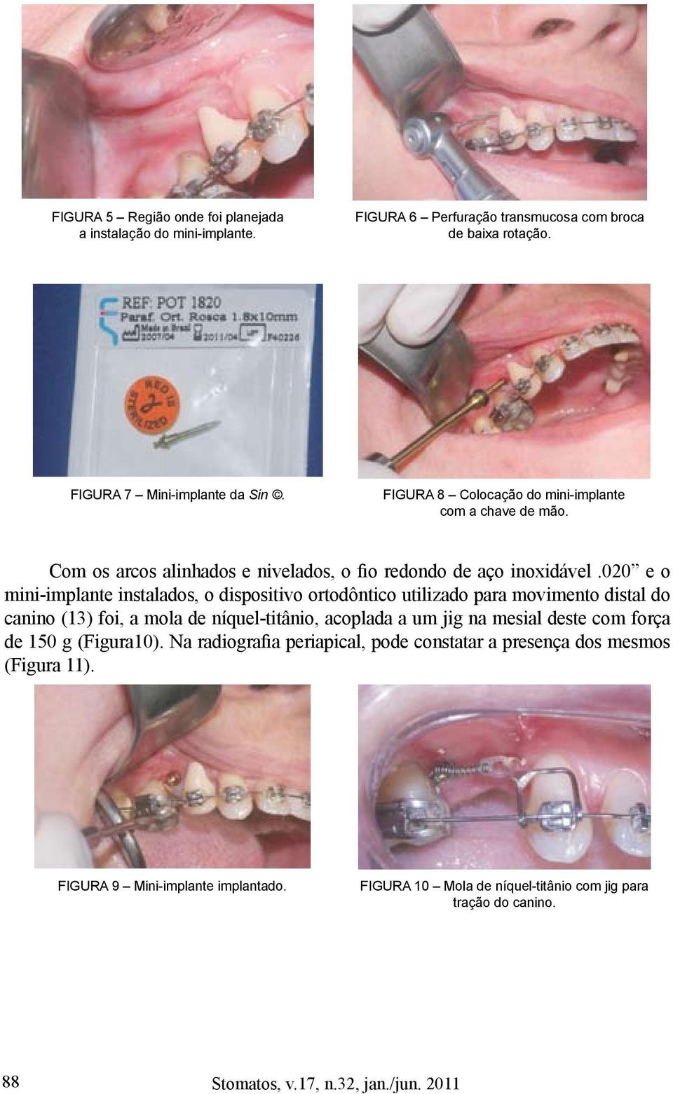 020 e o mini-implante instalados, o dispositivo ortodôntico utilizado para movimento distal do canino (13) foi, a mola de níquel-titânio, acoplada a um jig na mesial