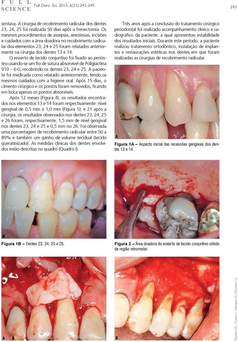 14. O enxerto de tecido conjuntivo foi fixado ao periósteo usando-se um fio de sutura absorvível de Poliglactina 910 6-0, recobrindo os dentes 23, 24 e 25.