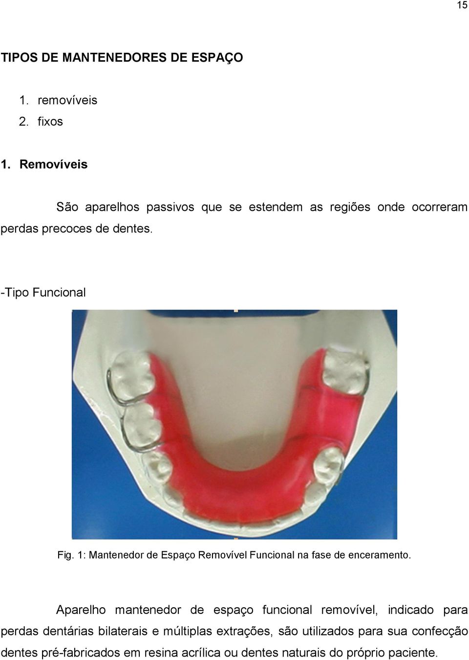 -Tipo Funcional Fig. 1: Mantenedor de Espaço Removível Funcional na fase de enceramento.