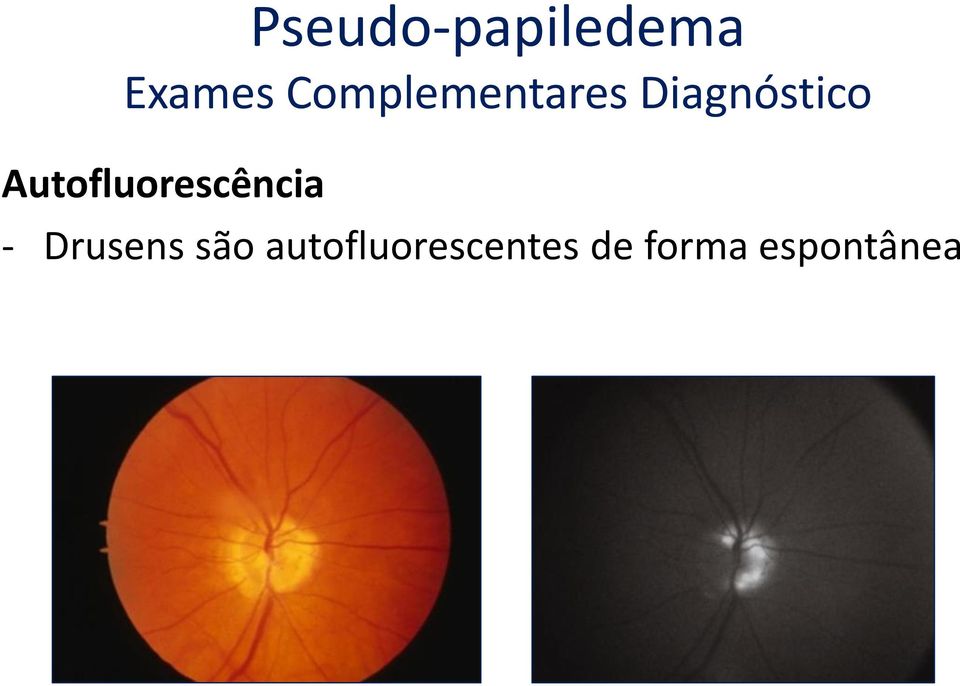 Autofluorescência - Drusens