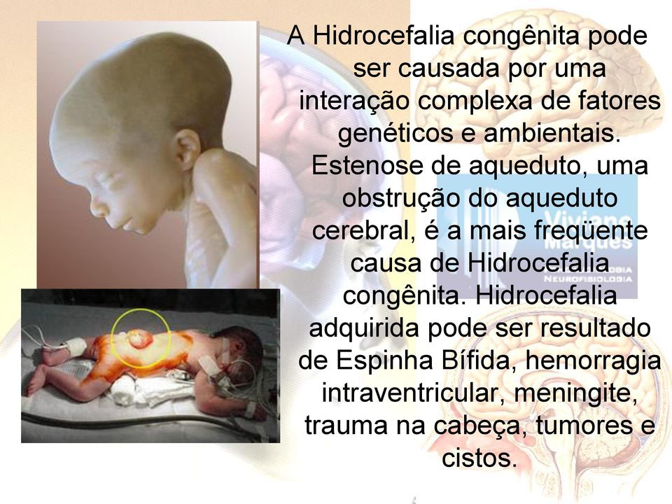 Estenose de aqueduto, uma obstrução do aqueduto cerebral, é a mais freqüente causa de