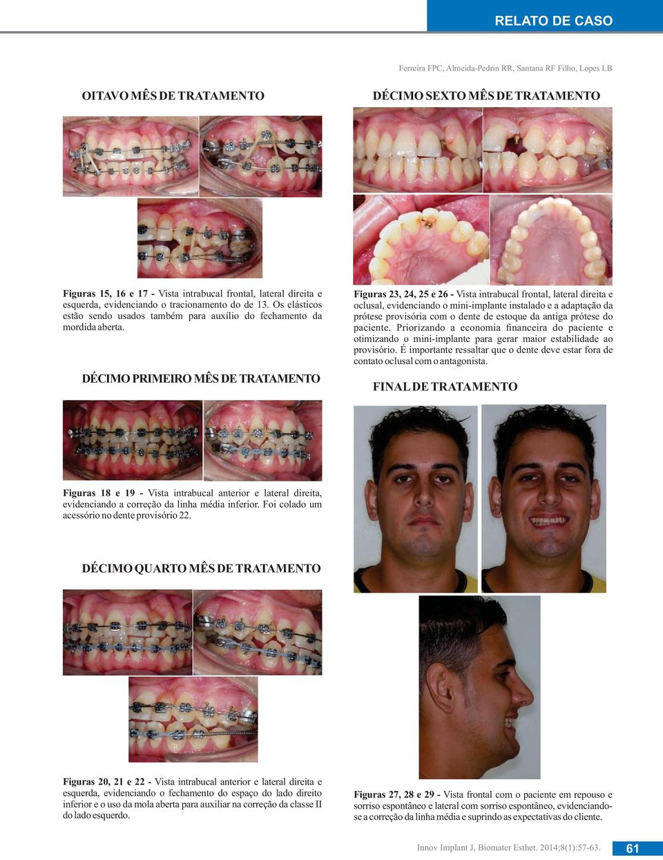DÉCIMO PRIMEIRO MÊS DE TRATAMENTO Figuras 23, 24, 25 e 26 - Vista intrabucal frontal, lateral direita e oclusal, evidenciando o mini-implante instalado e a adaptação da prótese provisória com o dente