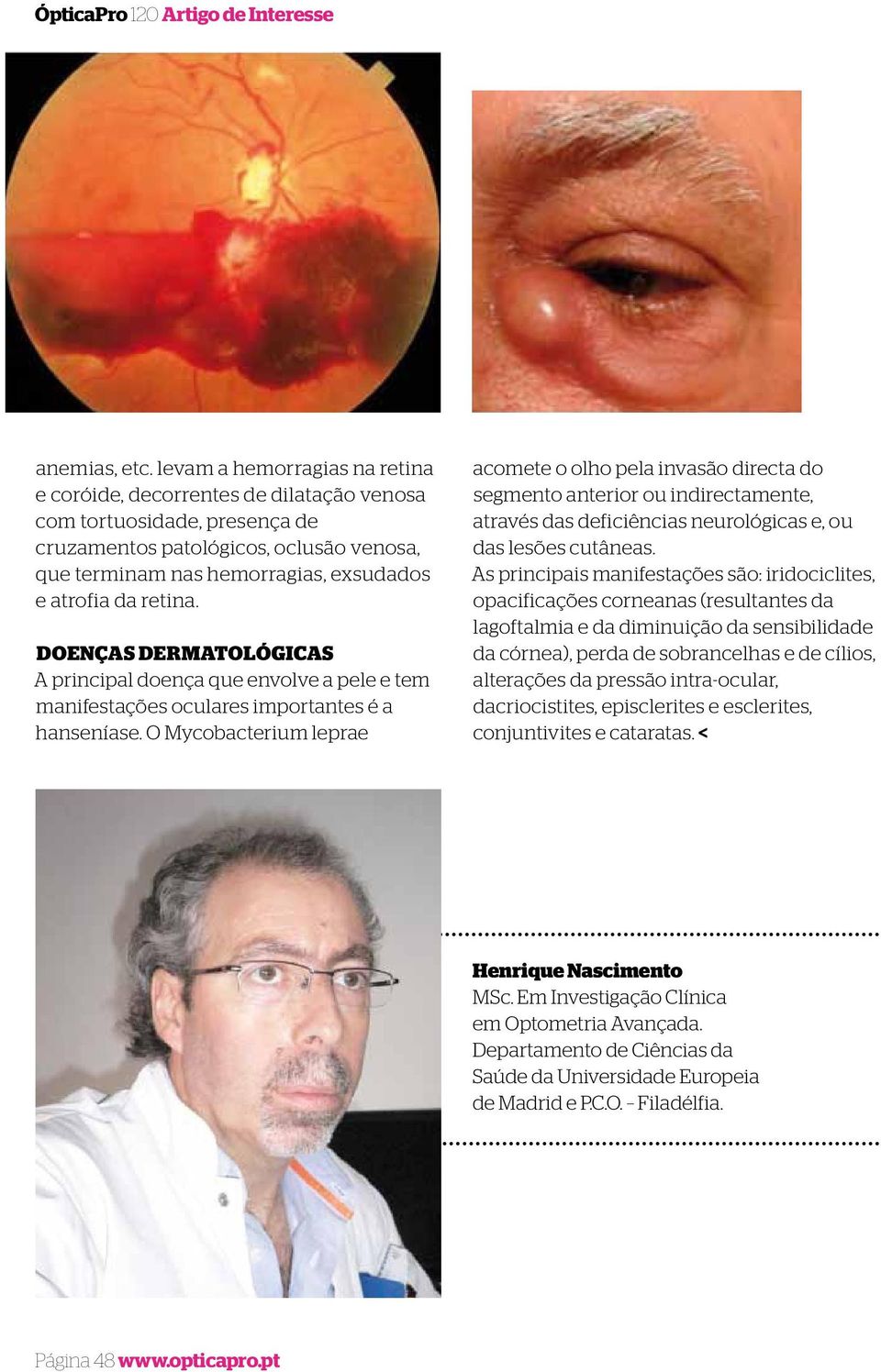 retina. DOENÇAS DERMATOLÓGICAS A principal doença que envolve a pele e tem manifestações oculares importantes é a hanseníase.