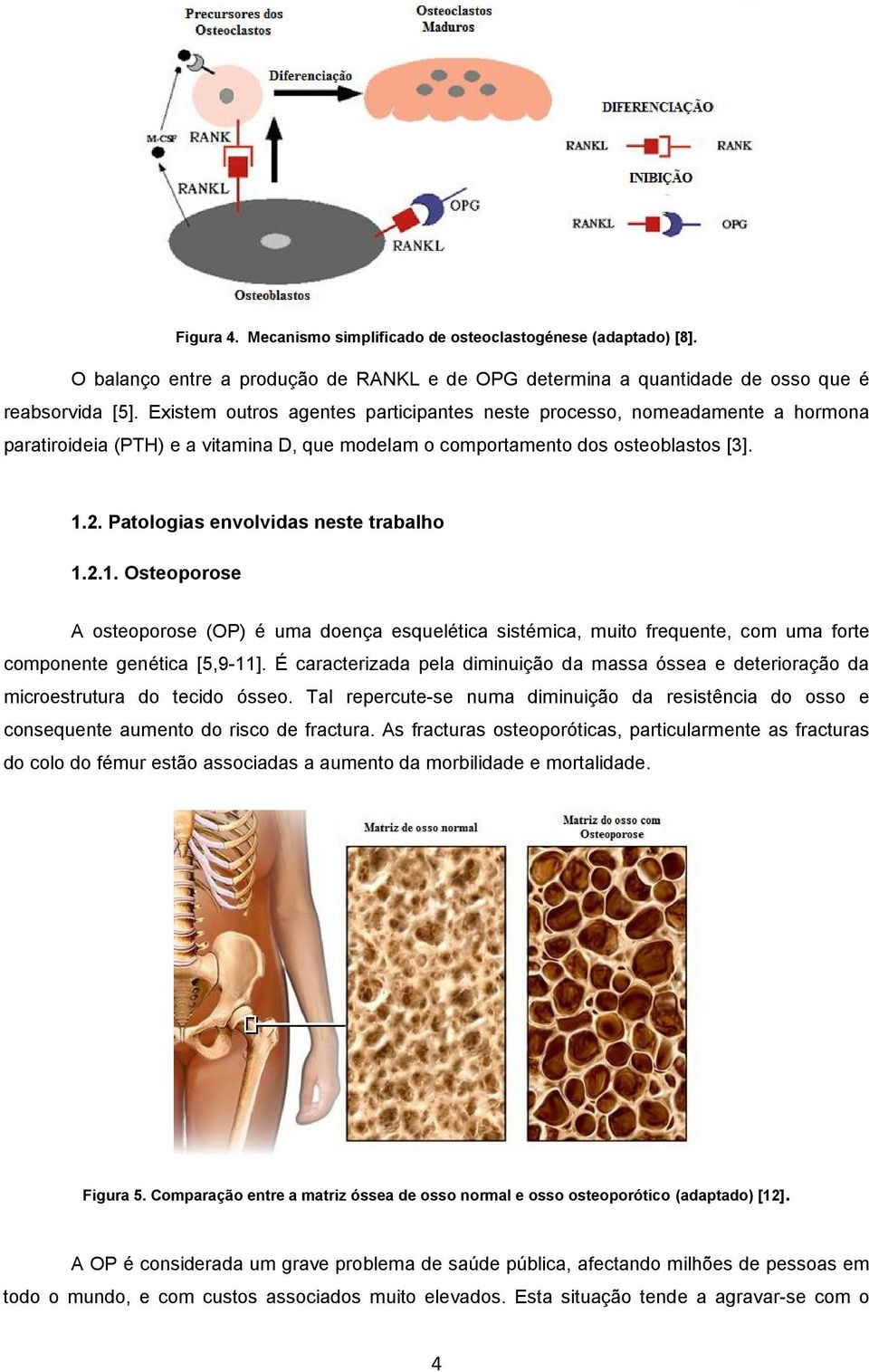 Patologias envolvidas neste trabalho 1.2.1. Osteoporose A osteoporose (OP) é uma doença esquelética sistémica, muito frequente, com uma forte componente genética [5,9-11].