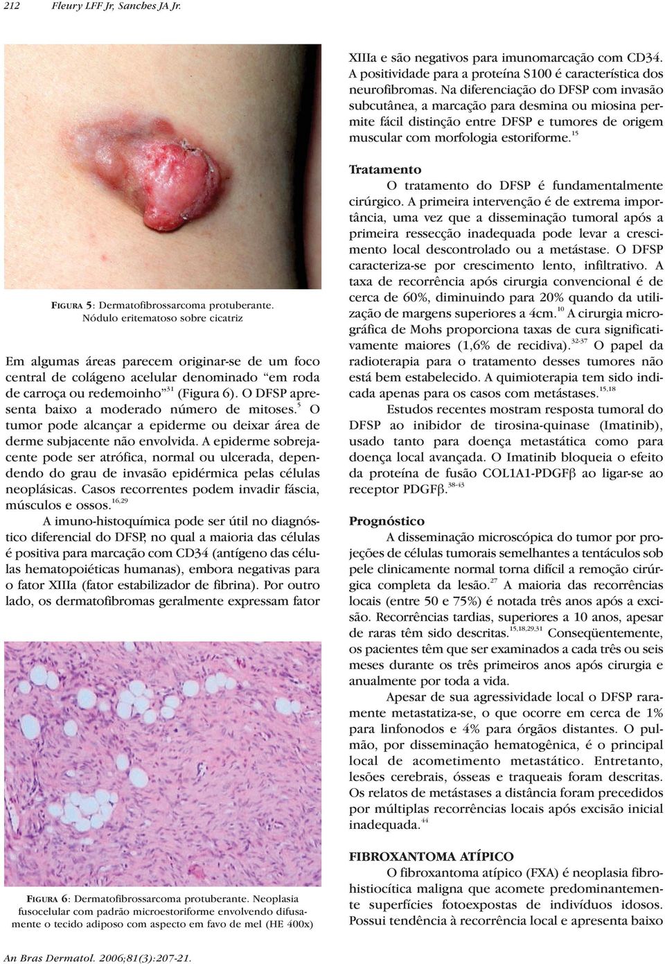 15 FIGURA 5: Dermatofibrossarcoma protuberante.