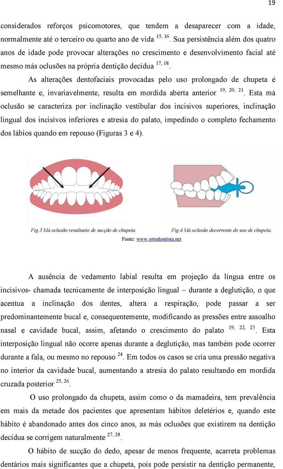 As alterações dentofaciais provocadas pelo uso prolongado de chupeta é semelhante e, invariavelmente, resulta em mordida aberta anterior 19, 20, 21.