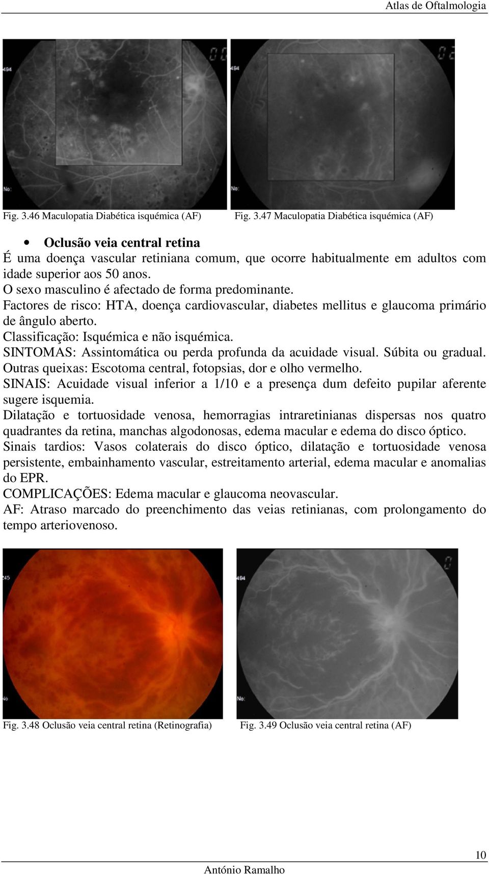 SINTOMAS: Assintomática ou perda profunda da acuidade visual. Súbita ou gradual. Outras queixas: Escotoma central, fotopsias, dor e olho vermelho.