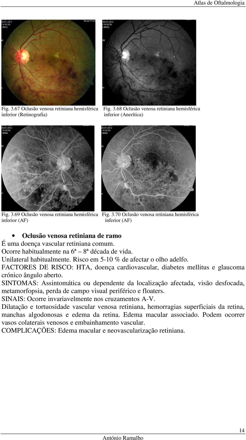 FACTORES DE RISCO: HTA, doença cardiovascular, diabetes mellitus e glaucoma crónico ângulo aberto.