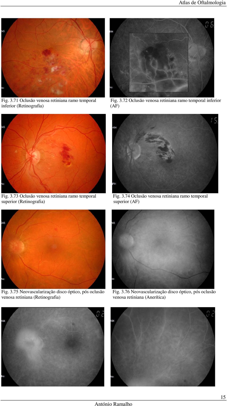 74 Oclusão venosa retiniana ramo temporal superior (AF) Fig. 3.