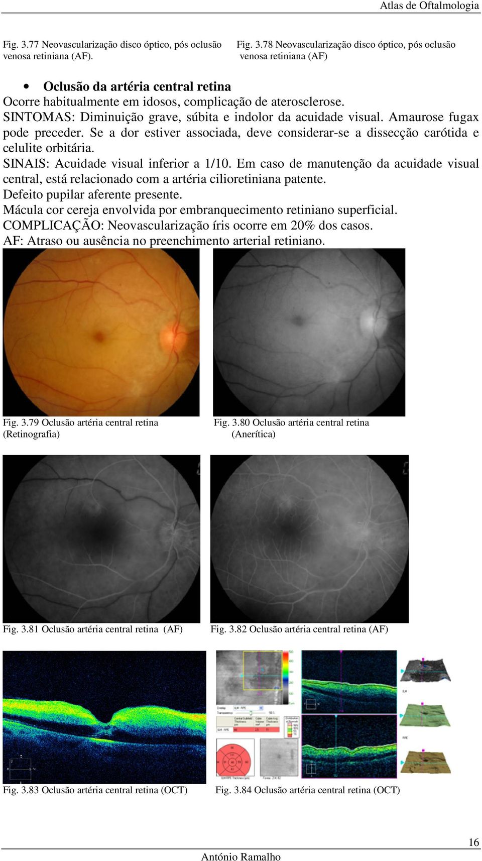 SINAIS: Acuidade visual inferior a 1/10. Em caso de manutenção da acuidade visual central, está relacionado com a artéria cilioretiniana patente. Defeito pupilar aferente presente.