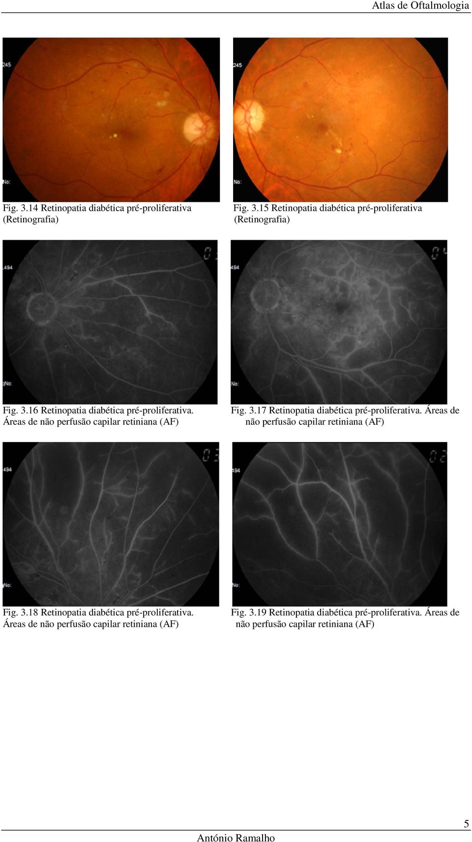 Áreas de não perfusão capilar retiniana (AF) Fig. 3.18 Retinopatia diabética pré-proliferativa.