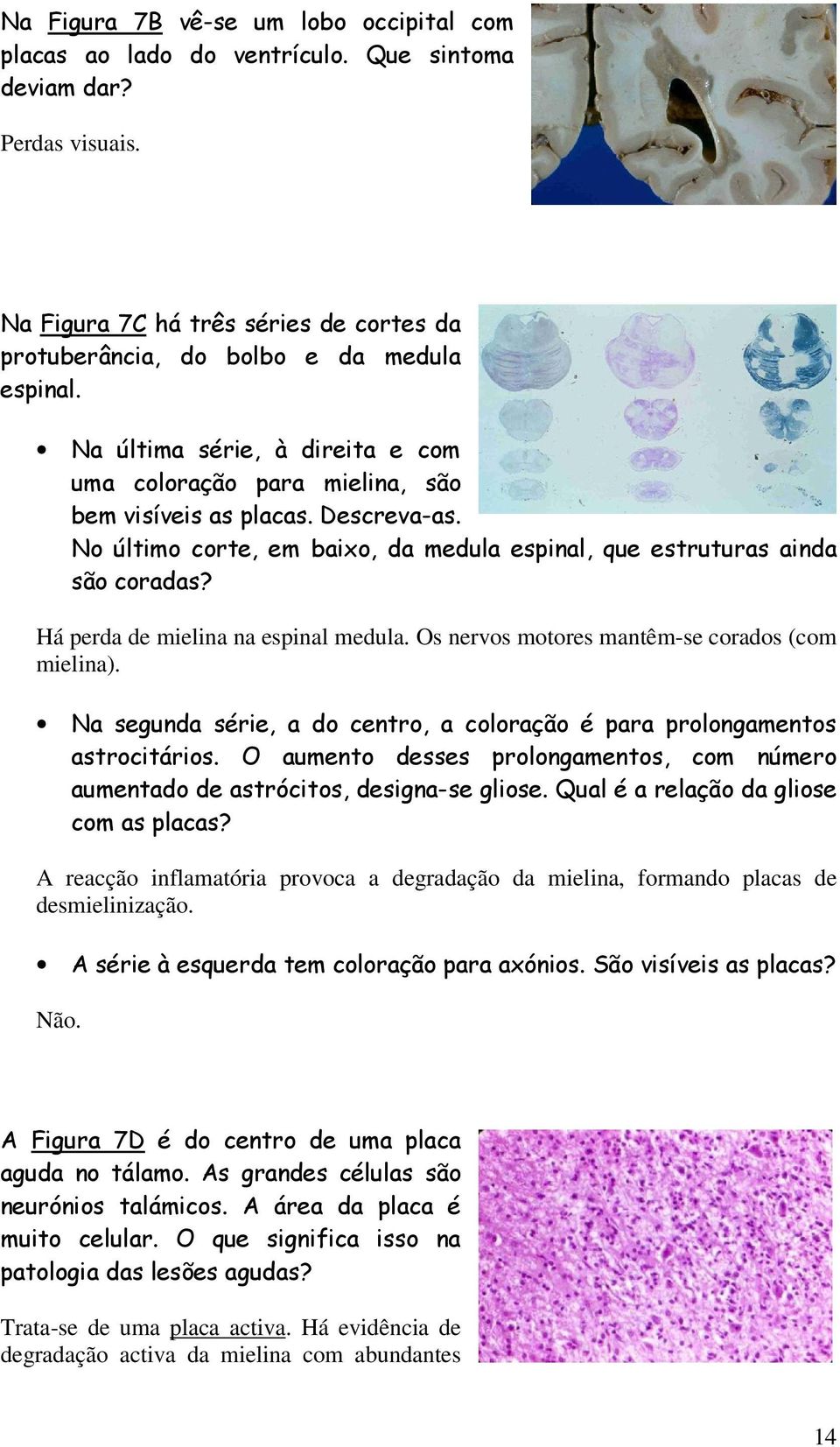 Há perda de mielina na espinal medula. Os nervos motores mantêm-se corados (com mielina). Na segunda série, a do centro, a coloração é para prolongamentos astrocitários.