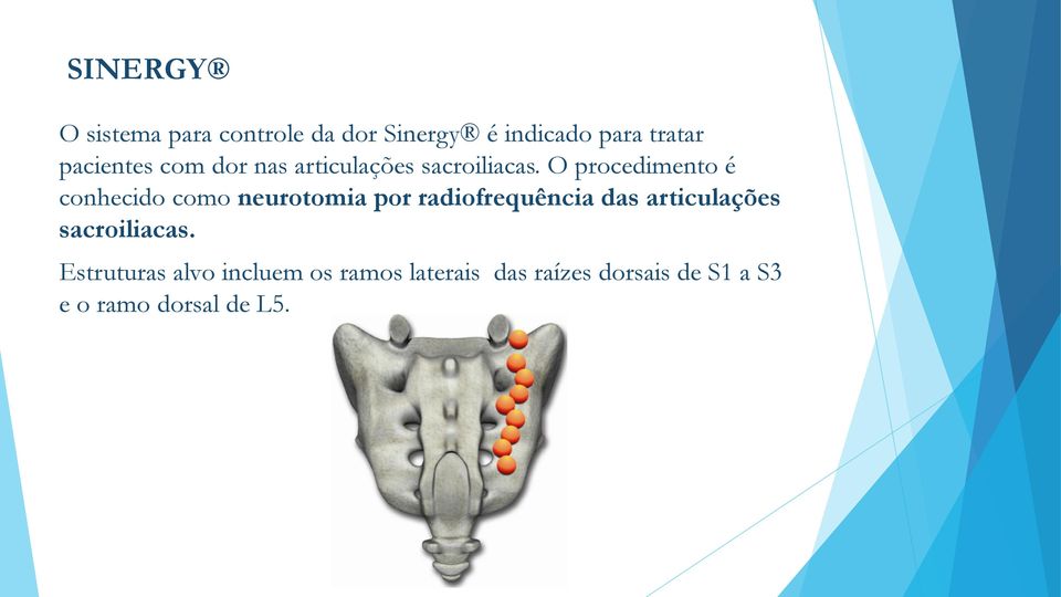 O procedimento é conhecido como neurotomia por radiofrequência das