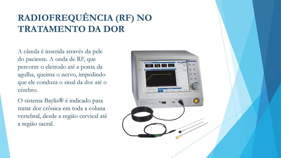 A onda de RF, que percorre o eletrodo até a ponta da agulha, queima o nervo, impedindo