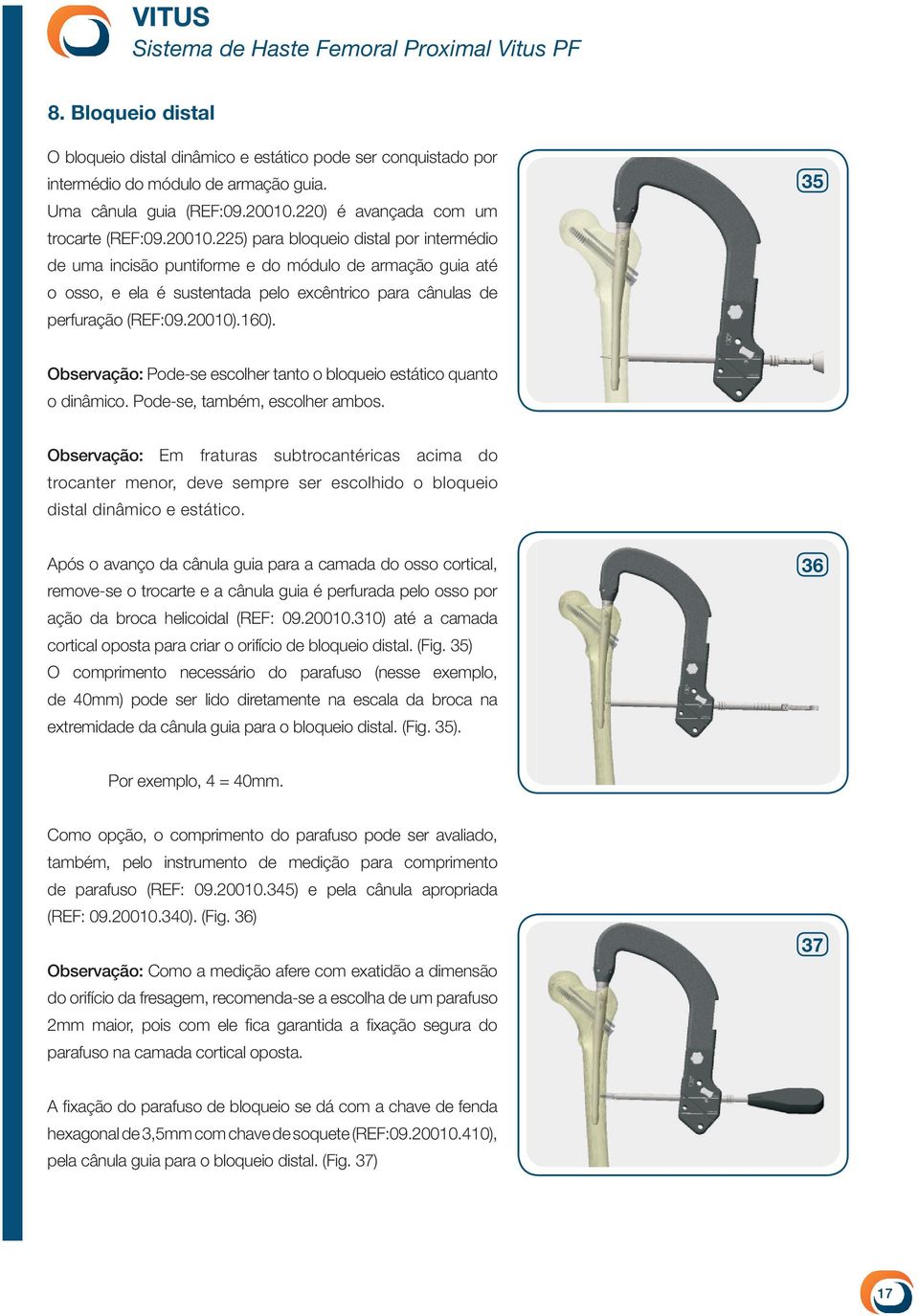 225) para bloqueio distal por intermédio de uma incisão puntiforme e do módulo de armação guia até o osso, e ela é sustentada pelo excêntrico para cânulas de perfuração (REF:09.20010).160).