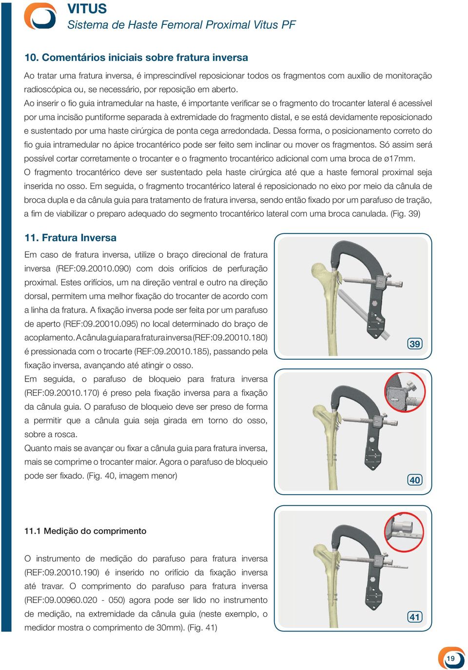 Ao inserir o fio guia intramedular na haste, é importante verificar se o fragmento do trocanter lateral é acessível por uma incisão puntiforme separada à extremidade do fragmento distal, e se está