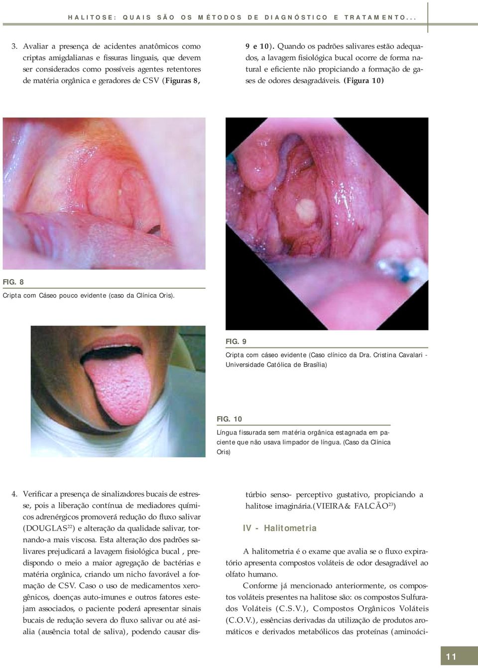 8, 9 e 10). Quando os padrões salivares estão adequados, a lavagem fisiológica bucal ocorre de forma natural e eficiente não propiciando a formação de gases de odores desagradáveis. (Figura 10) FIG.