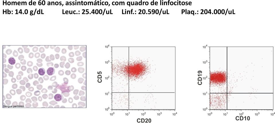 linfocitose Hb: 14.0 g/dl Leuc.