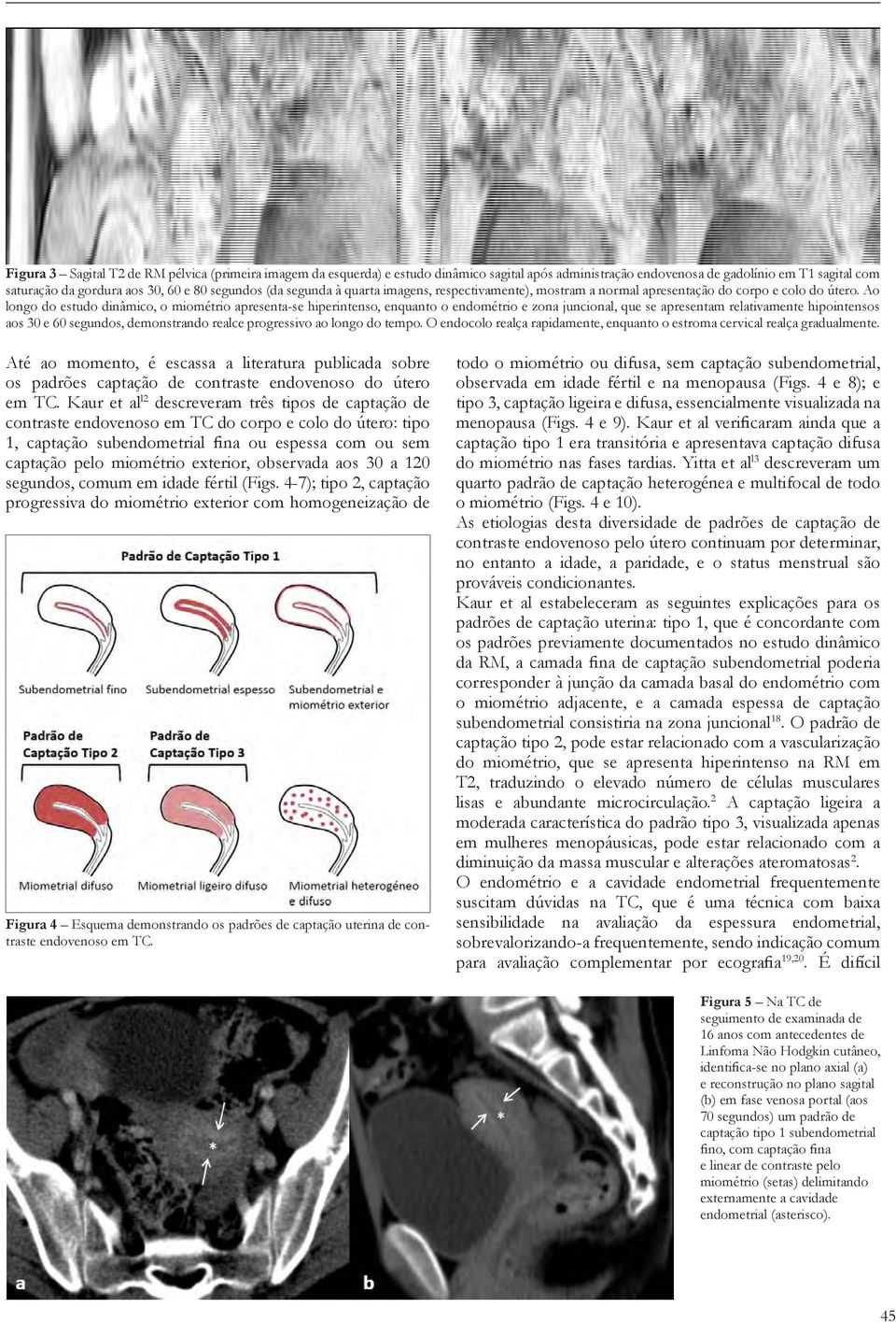 Ao longo do estudo dinâmico, o miométrio apresenta-se hiperintenso, enquanto o endométrio e zona juncional, que se apresentam relativamente hipointensos aos 30 e 60 segundos, demonstrando realce