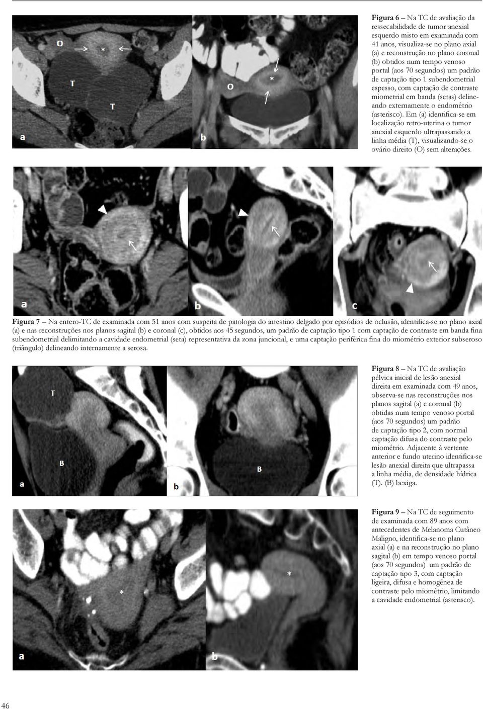 Em (a) identifica-se em localização retro-uterina o tumor anexial esquerdo ultrapassando a linha média (T), visualizando-se o ovário direito (O) sem alterações.