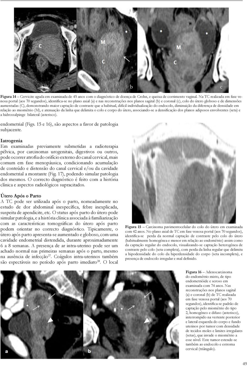 fase menopáusica, condicionando acumulação de conteúdo e distensão do canal cervical e/ou da cavidade endometrial a montante (Fig. 17), podendo simular patologia dos mesmos.