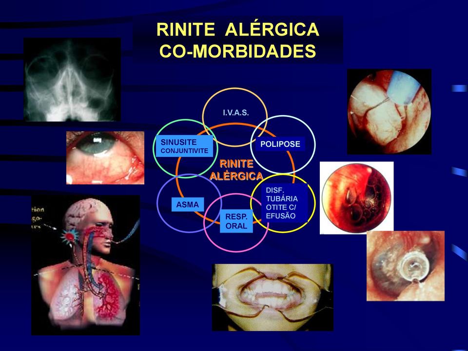 SINUSITE CONJUNTIVITE RINITE