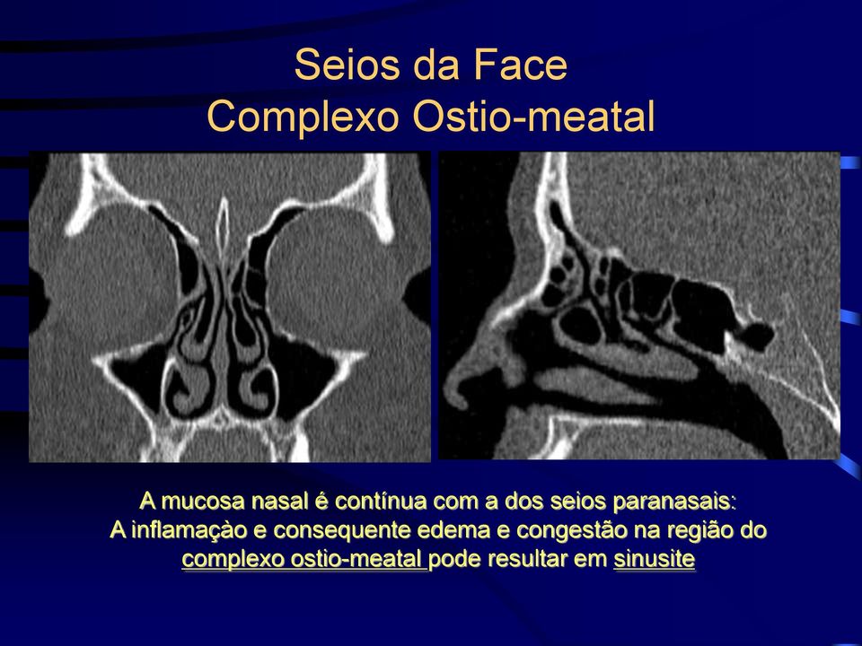 inflamaçào e consequente edema e congestão na