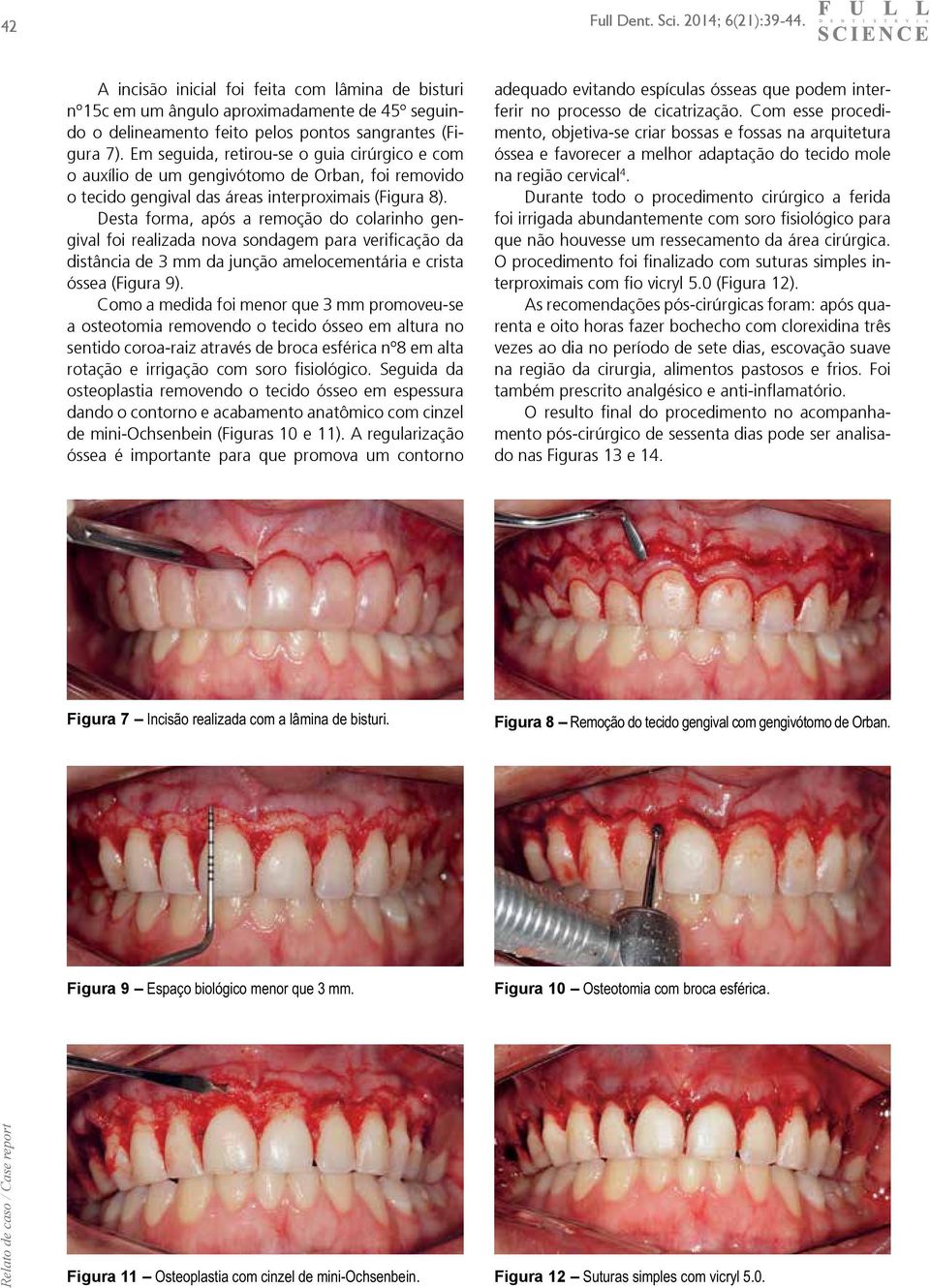 Desta forma, após a remoção do colarinho gengival foi realizada nova sondagem para verificação da distância de 3 mm da junção amelocementária e crista óssea (Figura 9).