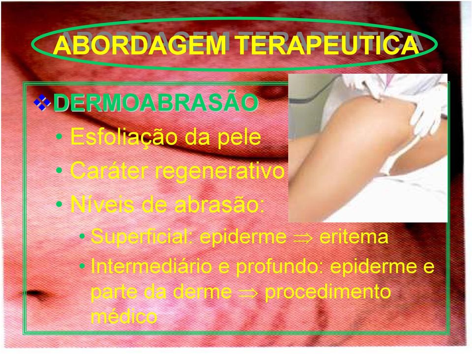 Níveis de abrasão: Superficial: epiderme eritema