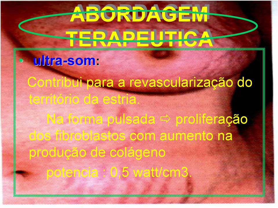 Na forma pulsada proliferação dos fibroblastos com