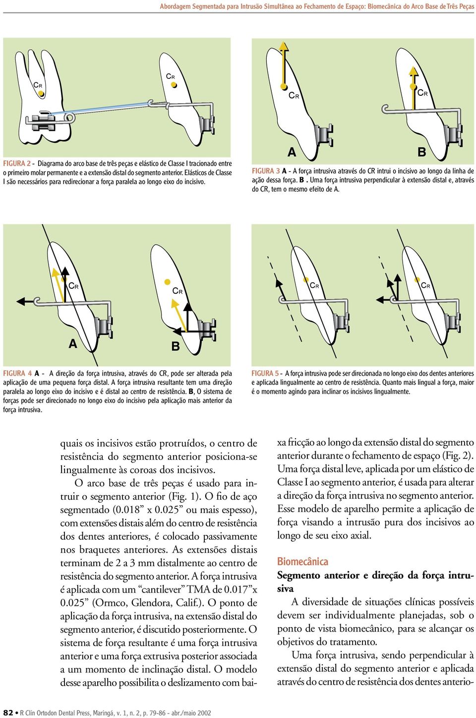 FIGUR 3 - força intrusiva através do intrui o incisivo ao longo da linha de ação dessa força.. Uma força intrusiva perpendicular à extensão distal e, através do, tem o mesmo efeito de.