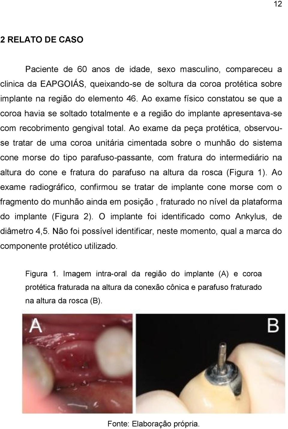 Ao exame da peça protética, observouse tratar de uma coroa unitária cimentada sobre o munhão do sistema cone morse do tipo parafuso-passante, com fratura do intermediário na altura do cone e fratura