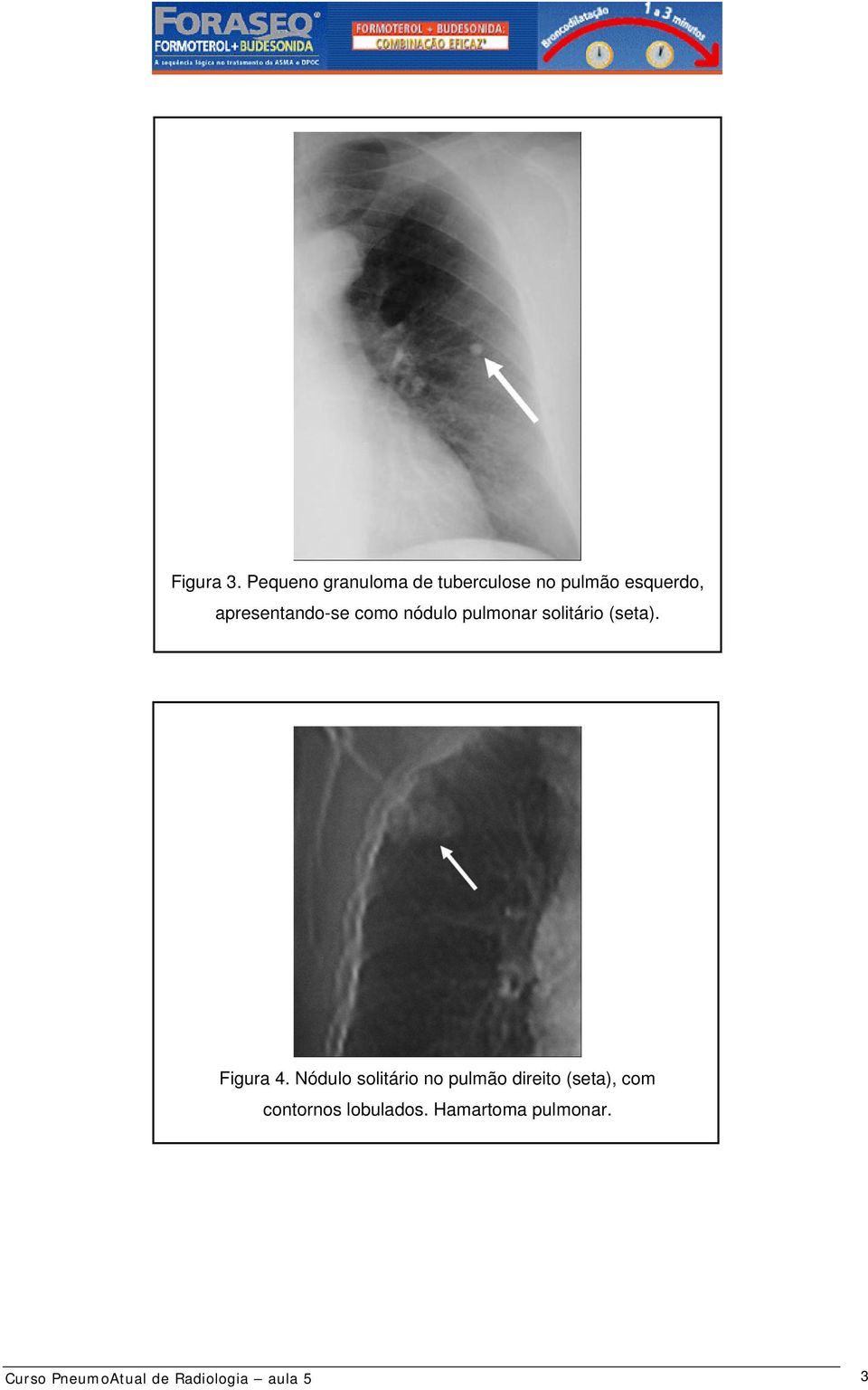 apresentando-se como nódulo pulmonar solitário (seta). Figura 4.