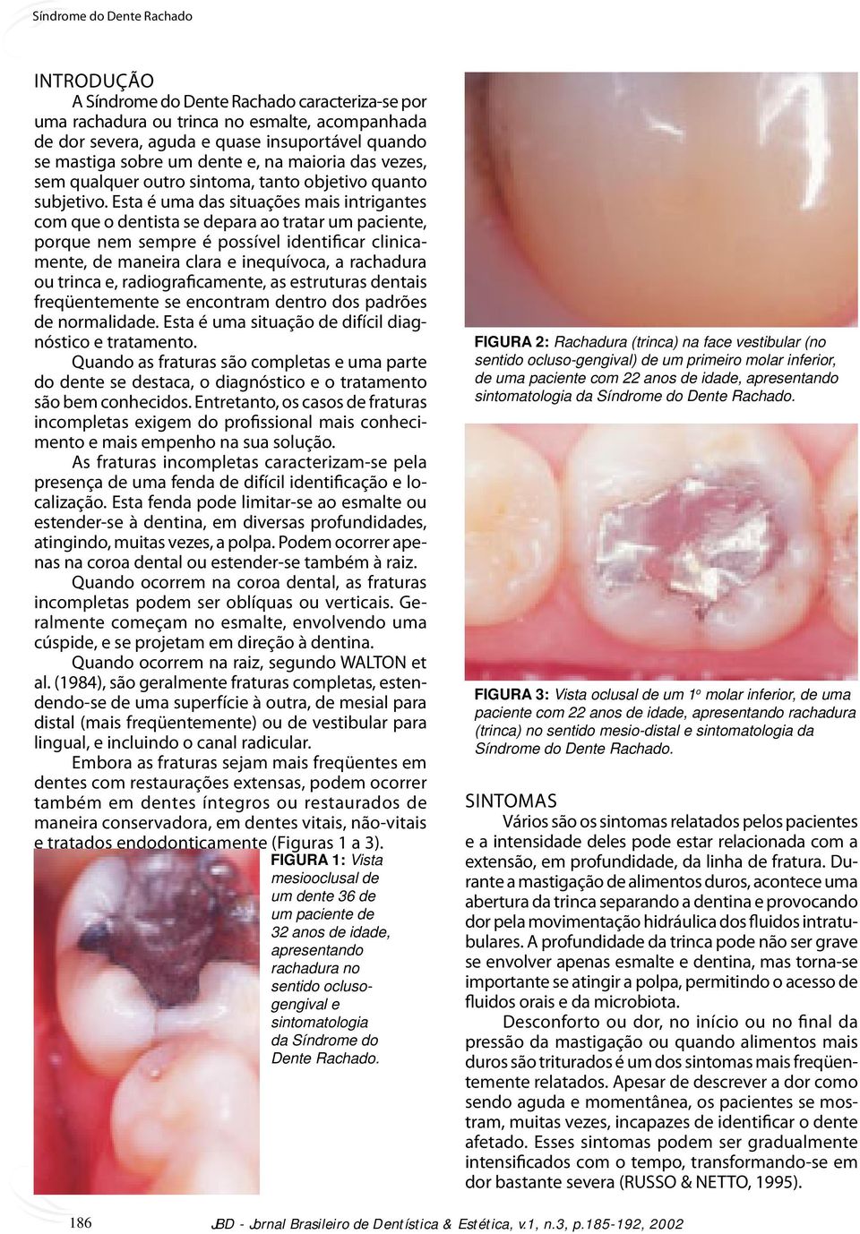 Esta é uma das situações mais intrigantes com que o dentista se depara ao tratar um paciente, porque nem sempre é possível identificar clinicamente, de maneira clara e inequívoca, a rachadura ou