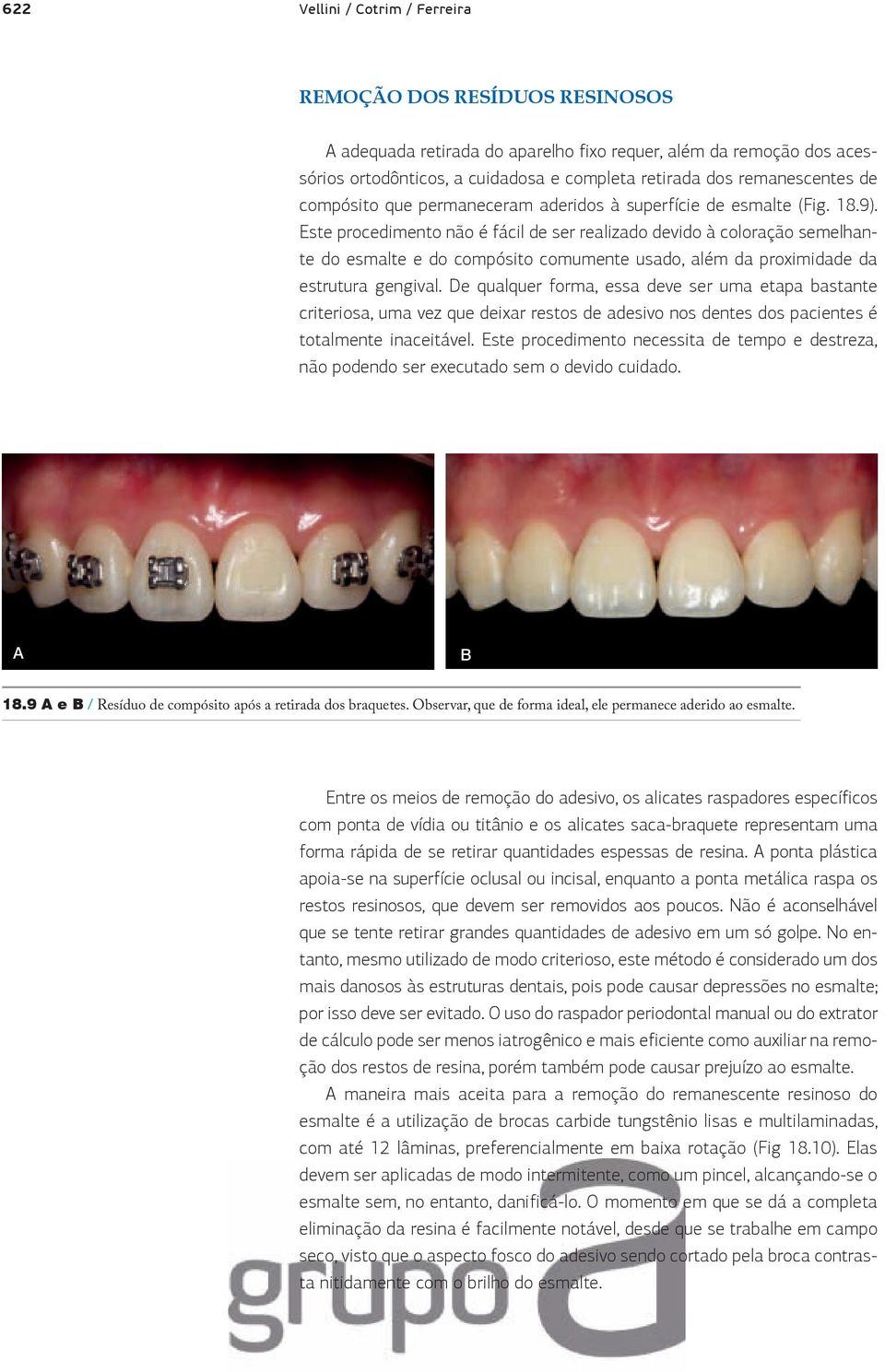 Este procedimento não é fácil de ser realizado devido à coloração semelhante do esmalte e do compósito comumente usado, além da proximidade da estrutura gengival.