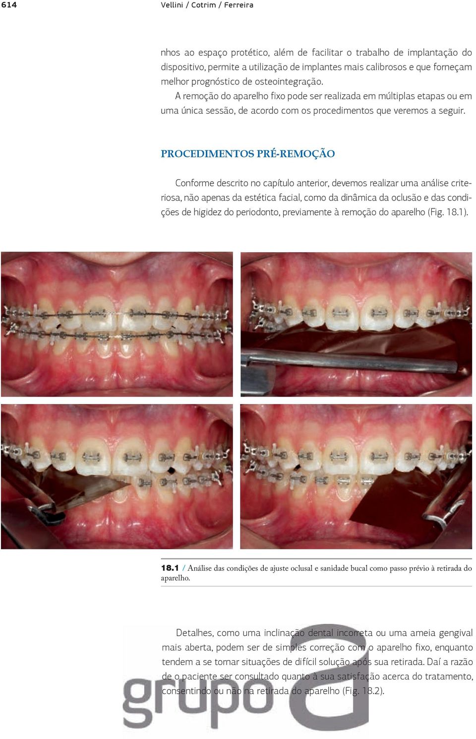 PROCEDIMENTOS PRÉ-REMOÇÃO Conforme descrito no capítulo anterior, devemos realizar uma análise criteriosa, não apenas da estética facial, como da dinâmica da oclusão e das condições de higidez do