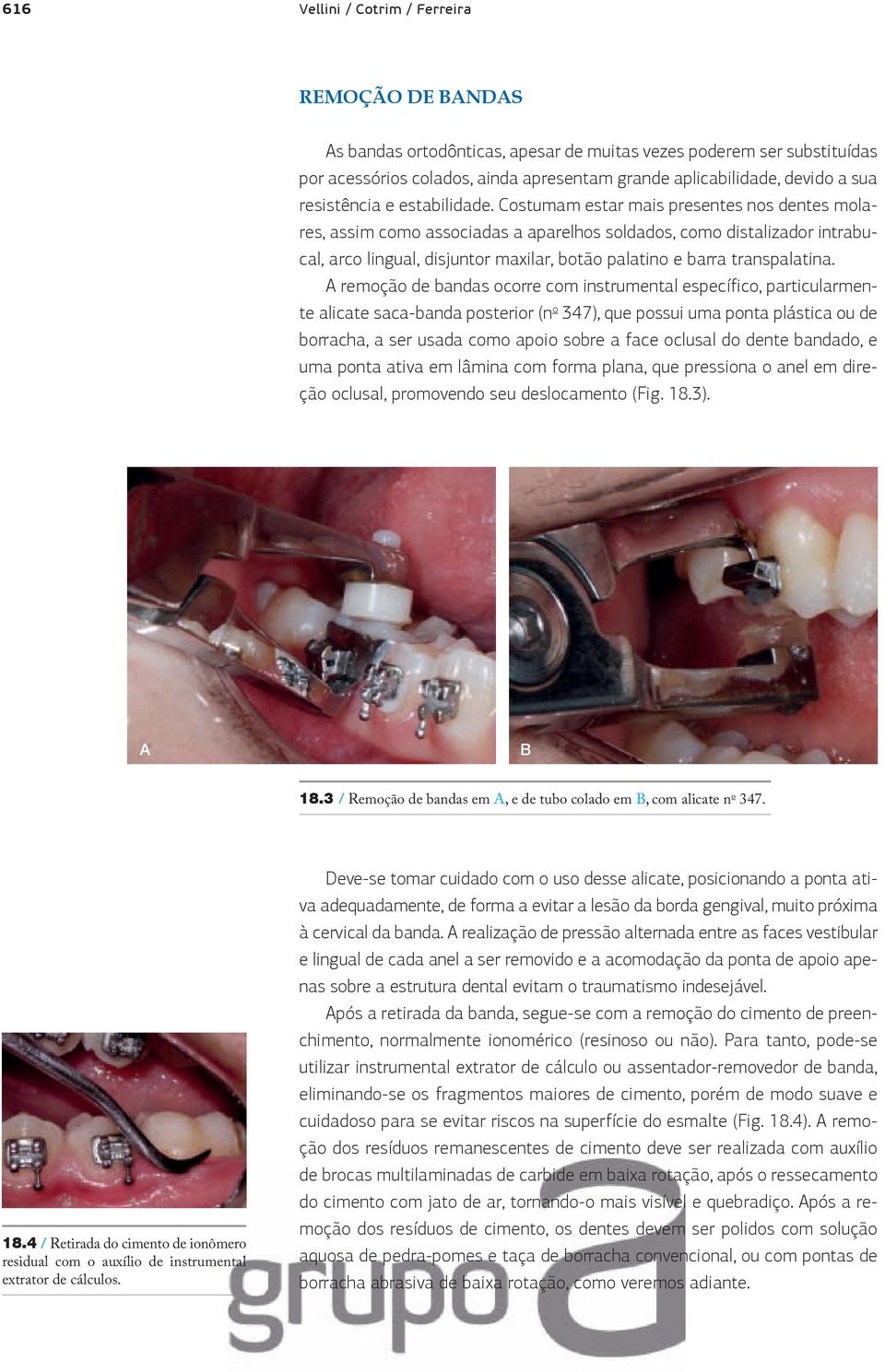 Costumam estar mais presentes nos dentes molares, assim como associadas a aparelhos soldados, como distalizador intrabucal, arco lingual, disjuntor maxilar, botão palatino e barra transpalatina.