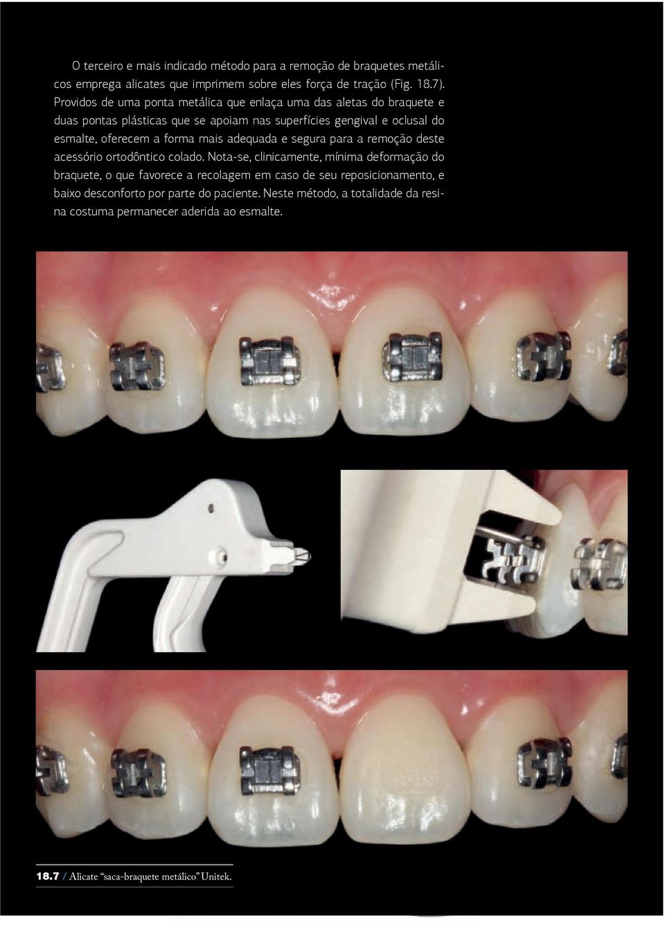 Providos de uma ponta metálica que enlaça uma das aletas do braquete e duas pontas plásticas que se apoiam nas superfícies gengival e oclusal do esmalte, oferecem a forma mais