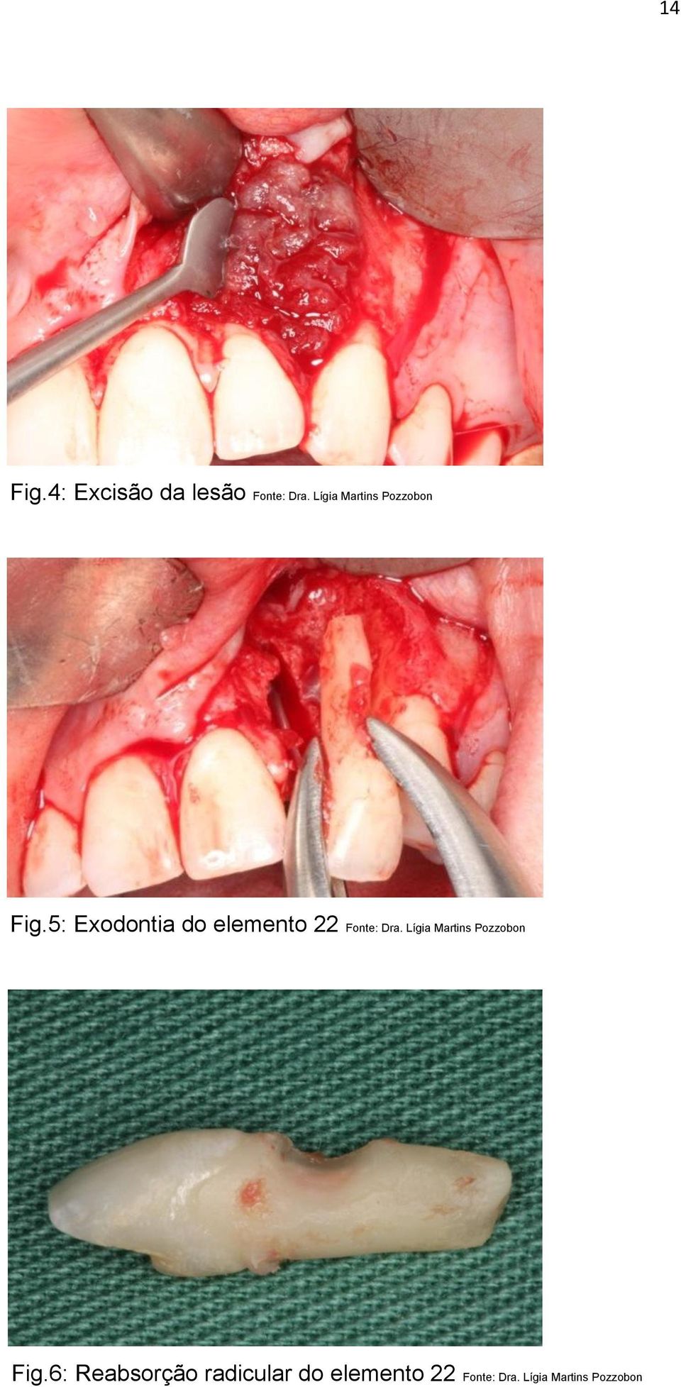 5: Exodontia do elemento 22 Fonte: Dra.