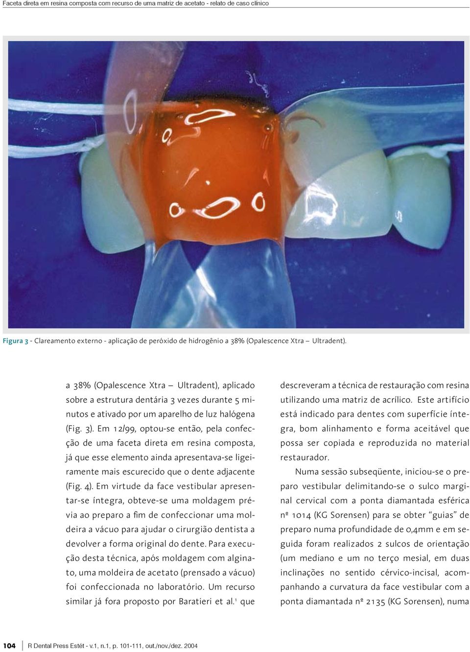 Em 12/99, optou-se então, pela confecção de uma faceta direta em resina composta, já que esse elemento ainda apresentava-se ligeiramente mais escurecido que o dente adjacente (Fig. 4).