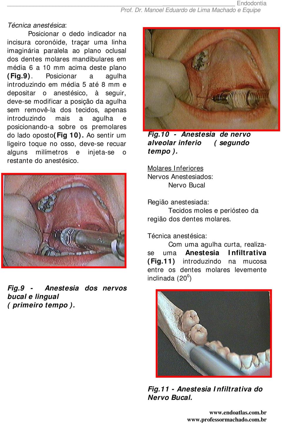 posicionando-a sobre os premolares do lado oposto(fig 10). Ao sentir um ligeiro toque no osso, deve-se recuar alguns milímetros e injeta-se o restante do anestésico. Fig.