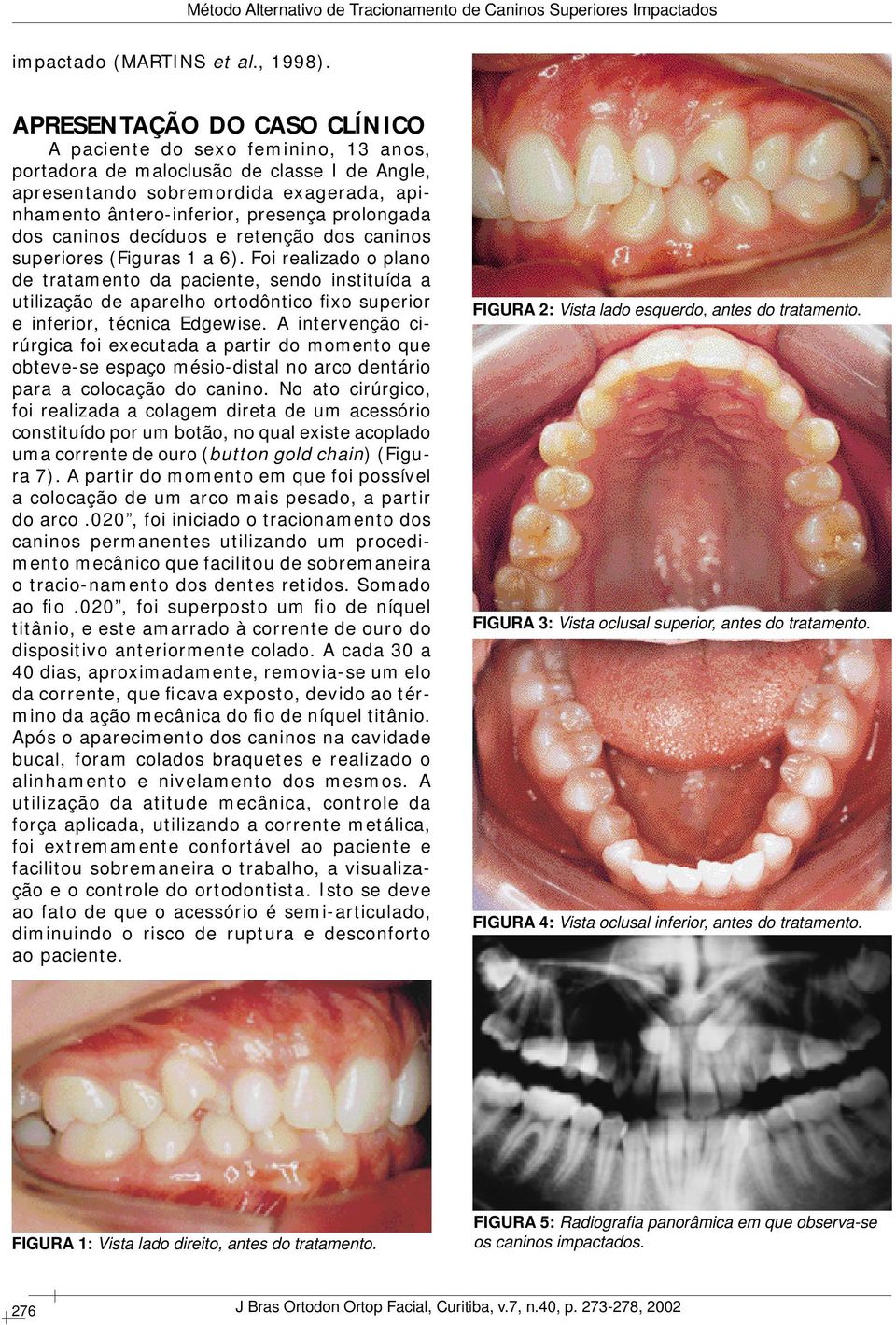 dos caninos decíduos e retenção dos caninos superiores (Figuras 1 a 6).