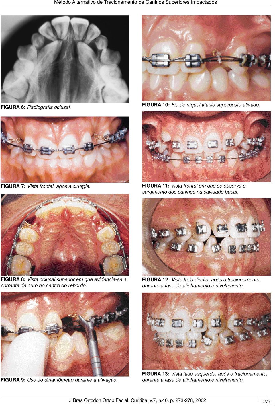 FIGURA 8: Vista oclusal superior em que evidencia-se a corrente de ouro no centro do rebordo.