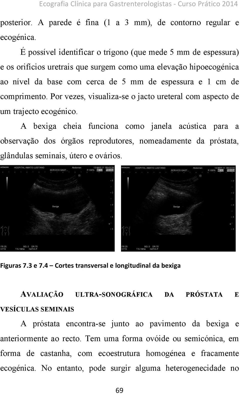 Por vezes, visualiza-se o jacto ureteral com aspecto de um trajecto ecogénico.