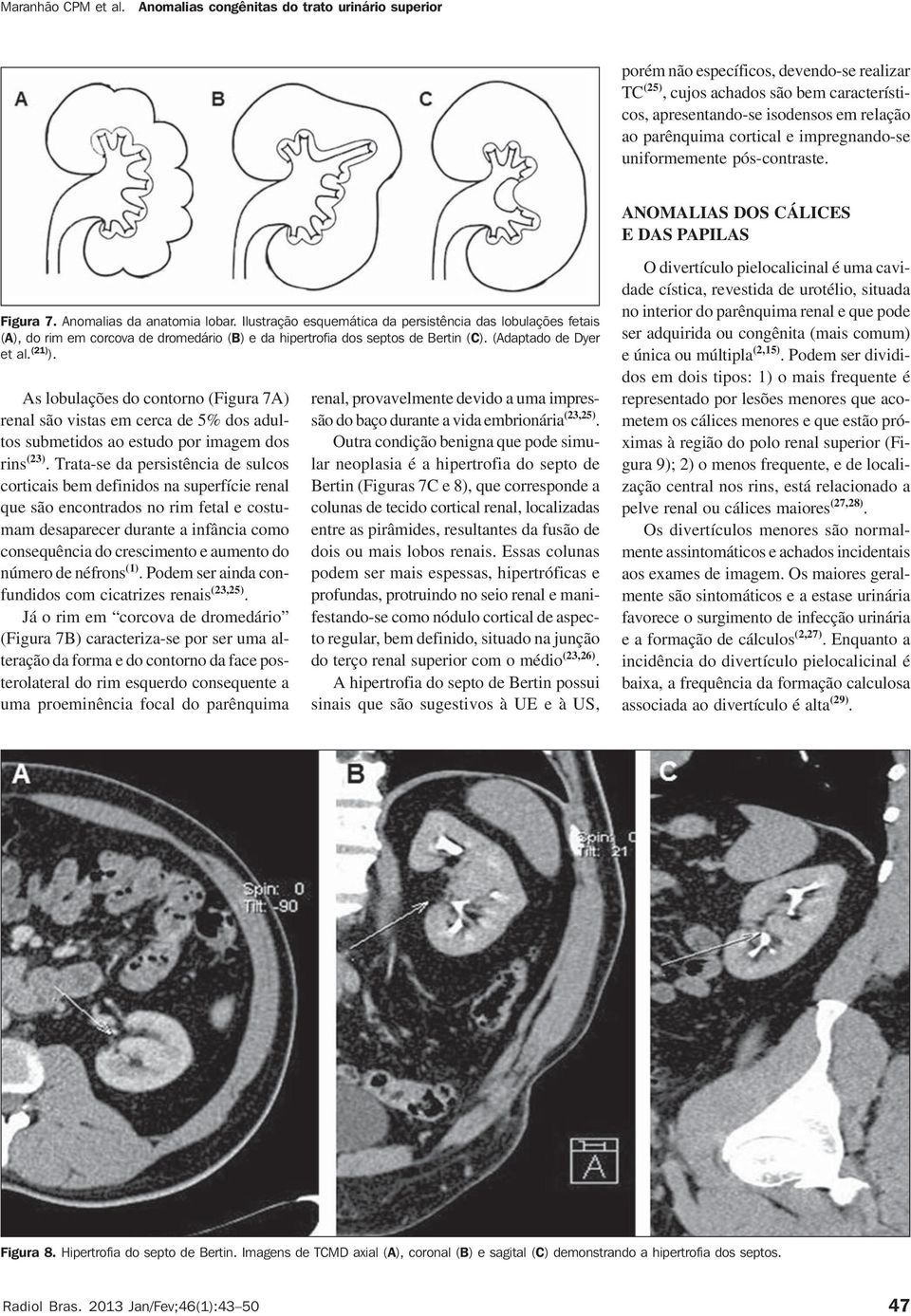 Ilustração esquemática da persistência das lobulações fetais (A), do rim em corcova de dromedário (B) e da hipertrofia dos septos de Bertin (C). (Adaptado de Dyer et al. (21) ).