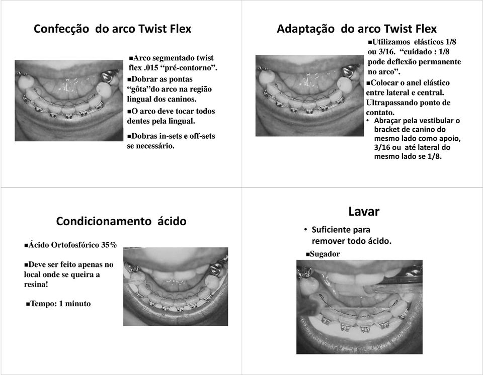 cuidado : 1/8 pode deflexão permanente no arco. Colocar o anel elástico entre lateral e central. Ultrapassando ponto de contato.