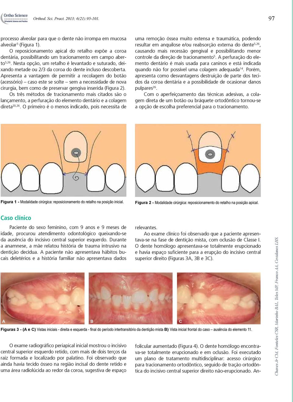 Nesta opção, um retalho é levantado e suturado, deixando metade ou 2/3 da coroa do dente incluso descoberta.