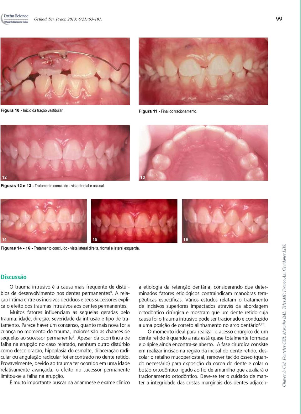 Discussão O trauma intrusivo é a causa mais frequente de distúrbios de desenvolvimento nos dentes permanentes 8.