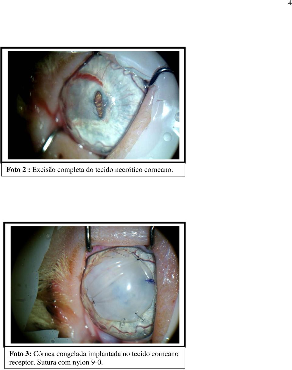 Foto 3: Córnea congelada implantada
