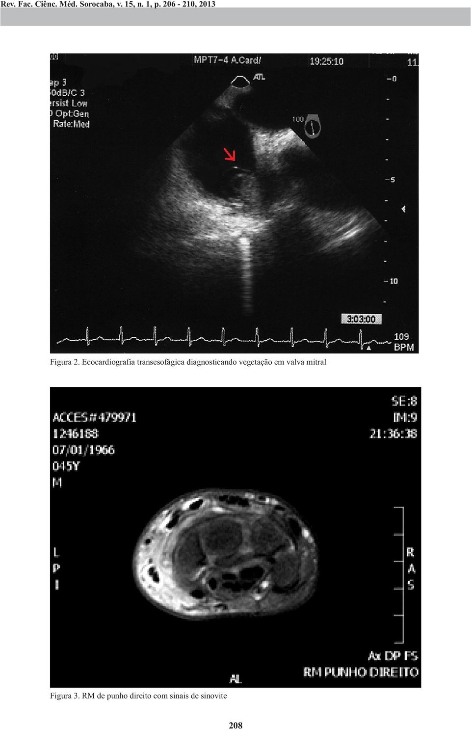 Ecocardiografia transesofágica diagnosticando